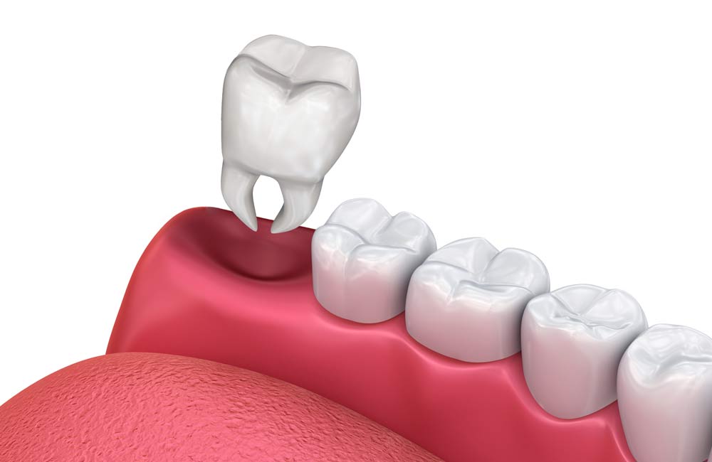 Illustration of a tooth extraction.