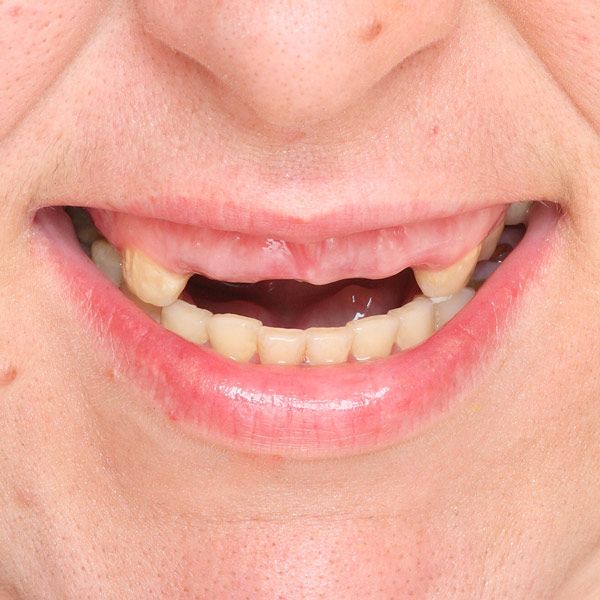 Smile with missing front teeth