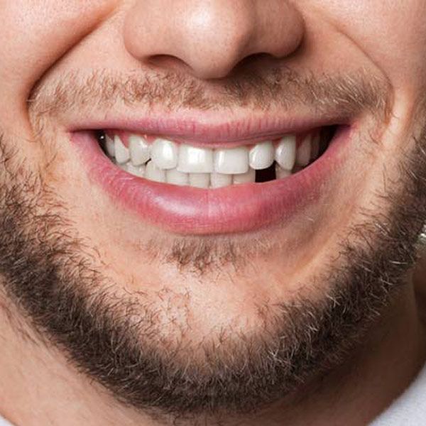 Smile with one missing tooth