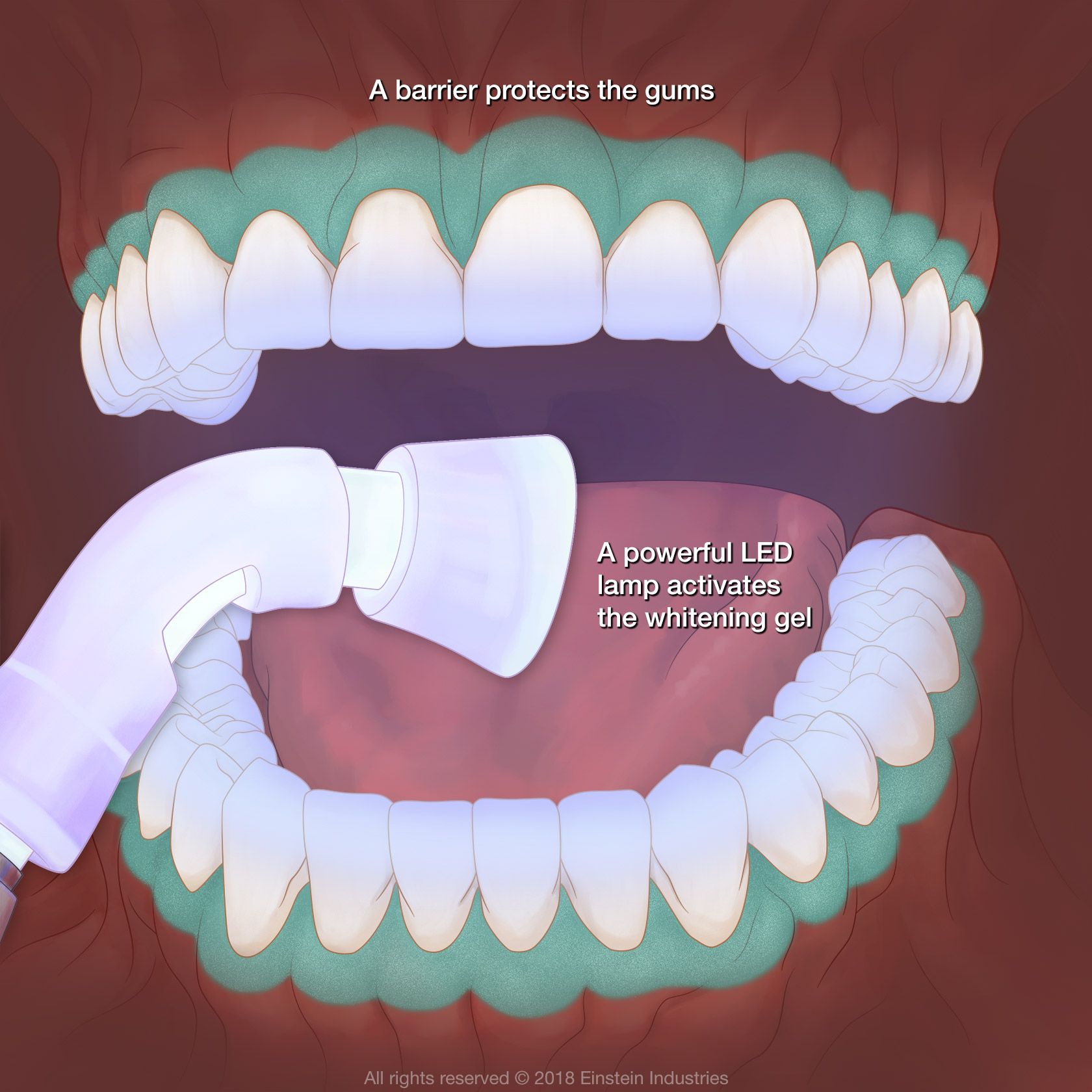 teeth whitening